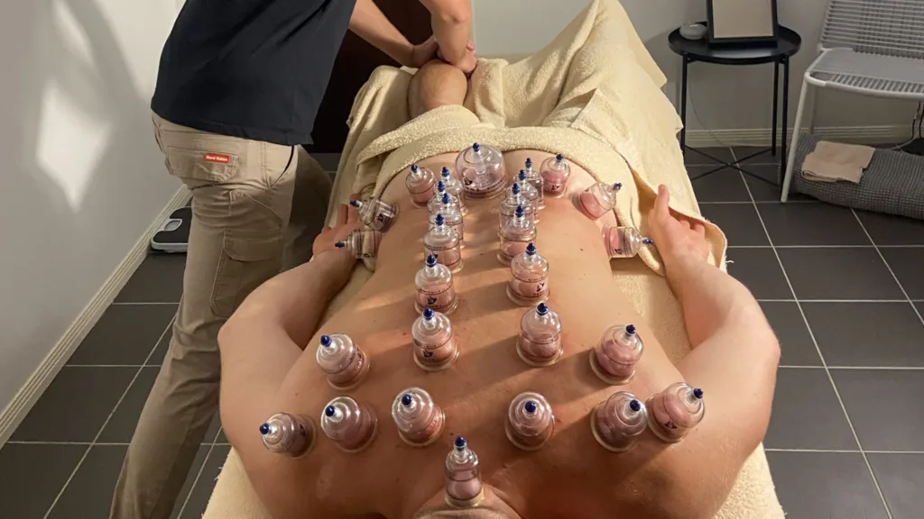 Cupping Therapy: Discover Its Healing Benefits For Mind And Body 2 A Soothing Cupping Therapy Session Aimed At Easing Pain, Reducing Stress, And Supporting Overall Well-Being.